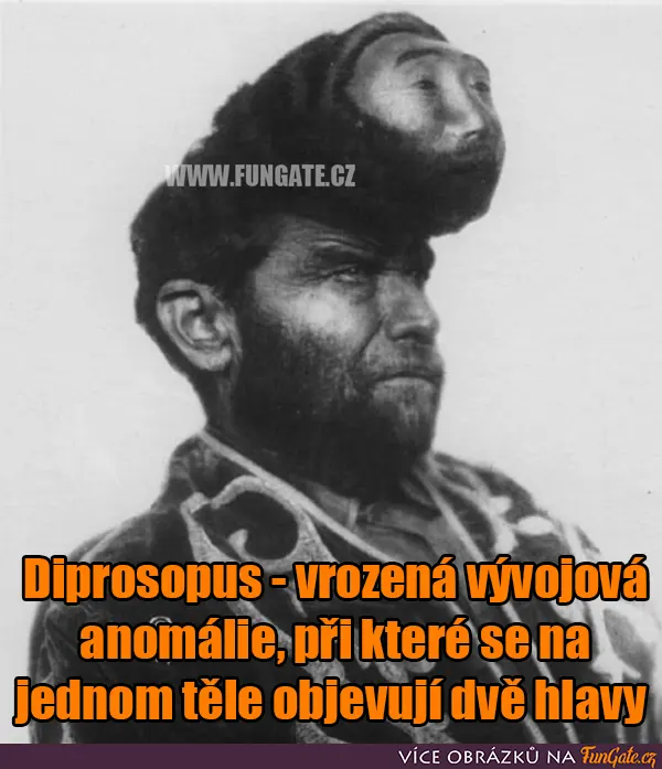 Diprosopus